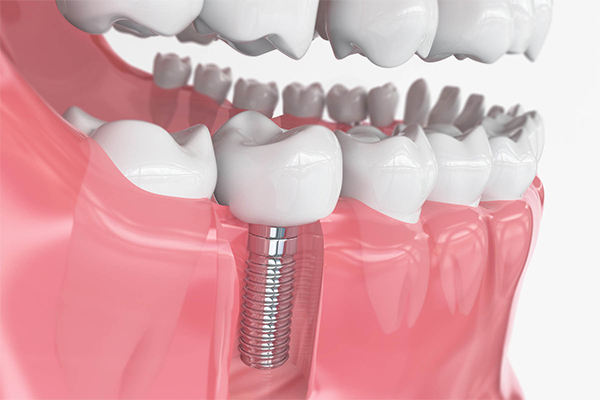 مزایای ایمپلنت فوری در دندانپزشکی