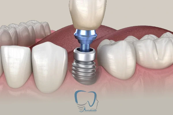 ایمپلنت توسط جراح فک و صورت