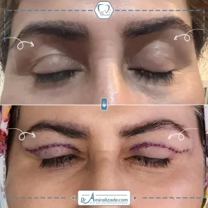 بلفاروپلاستی پلک بالا